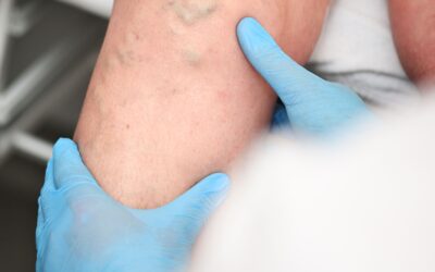Tratamientos avanzados para varices y salud vascular en Ecuador