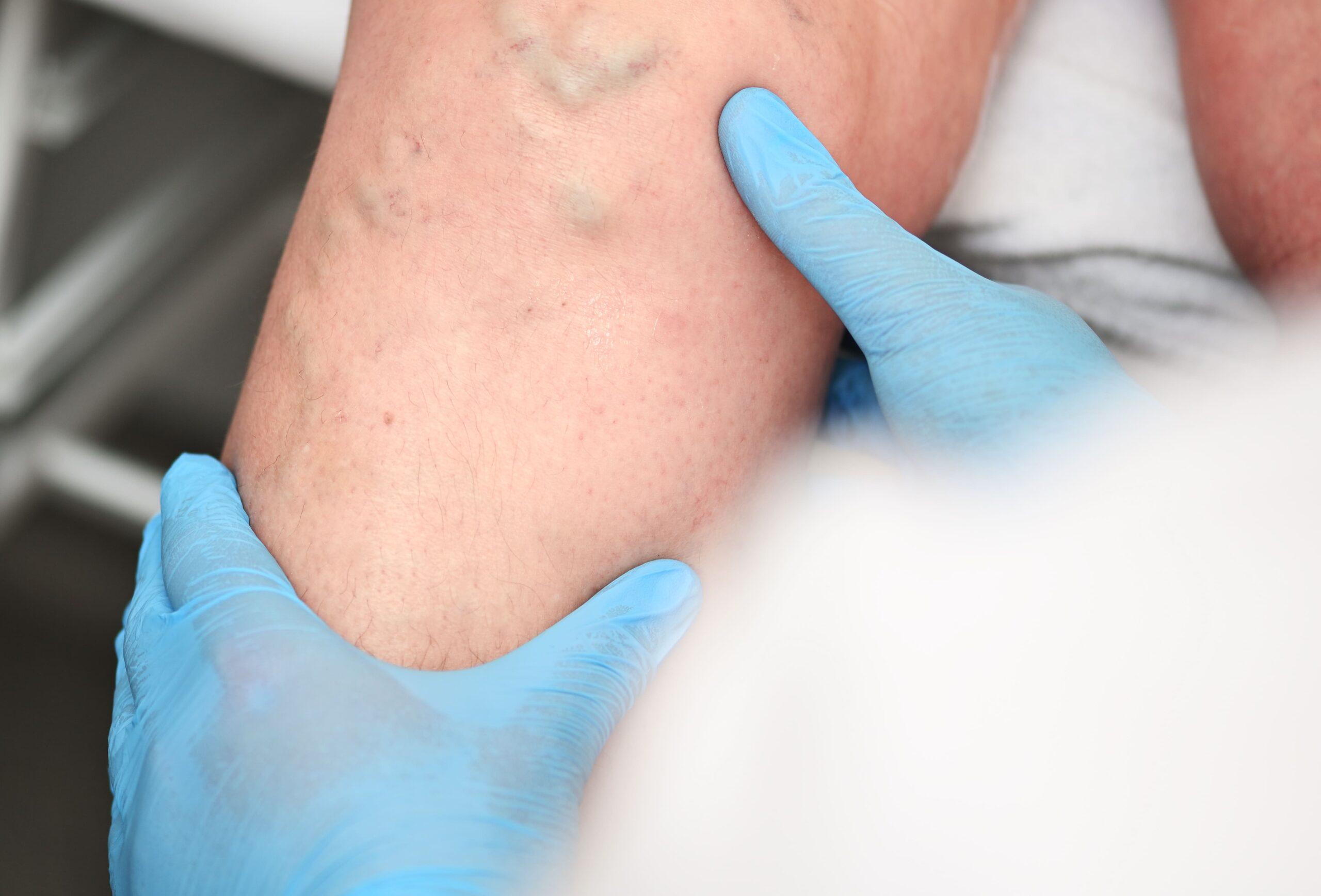 Tratamientos avanzados para varices y salud vascular en Ecuador