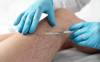 Sclerotherapy: the effective solution to eliminate varicose veins in Ecuador