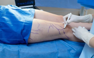 Escleroterapia: la solución efectiva para eliminar varices en Ecuador