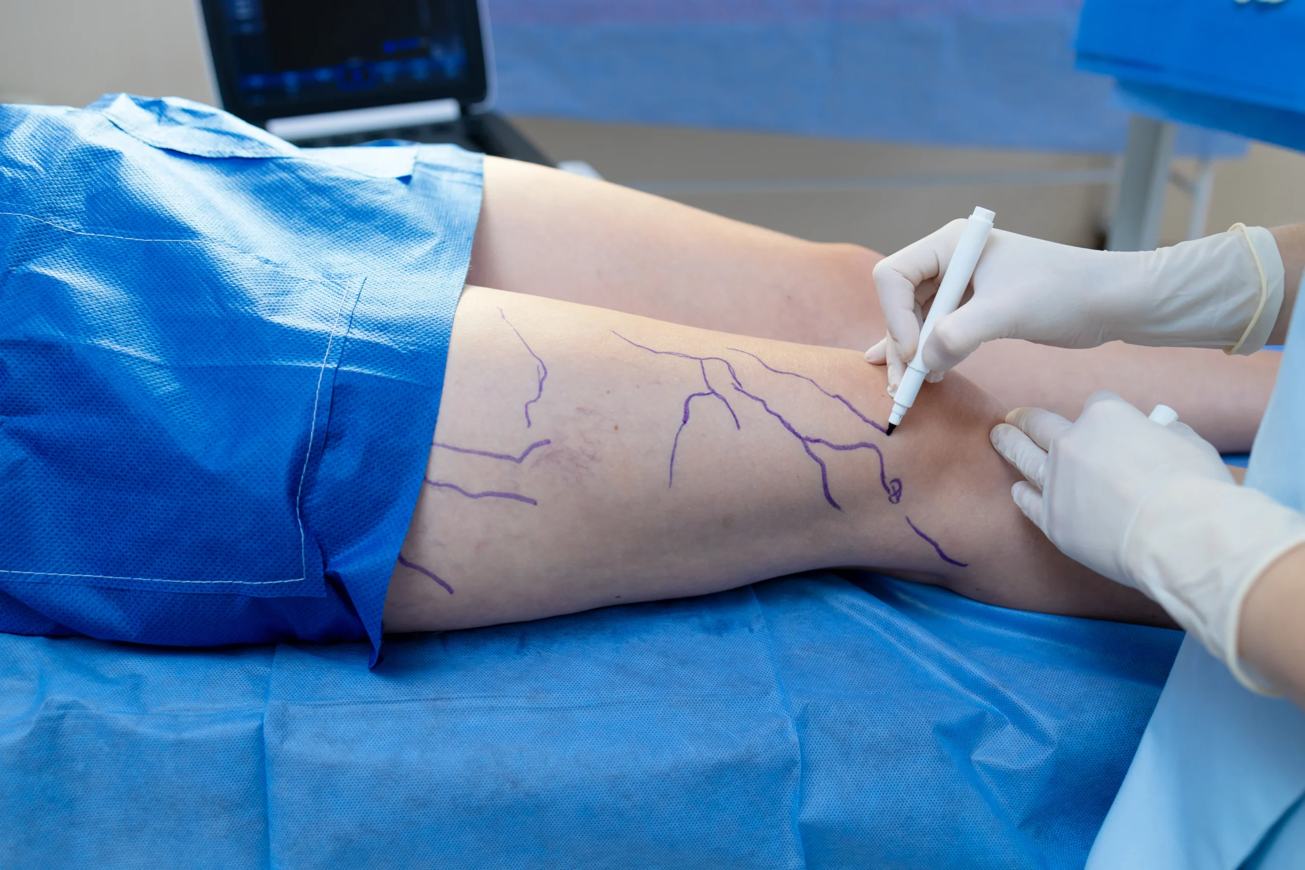 preparing-for-a-vein-treatment-in-hospital-setting-